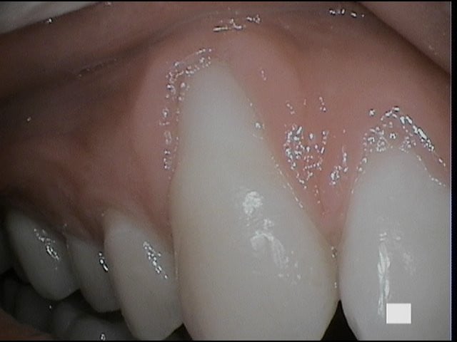 4-#6 before