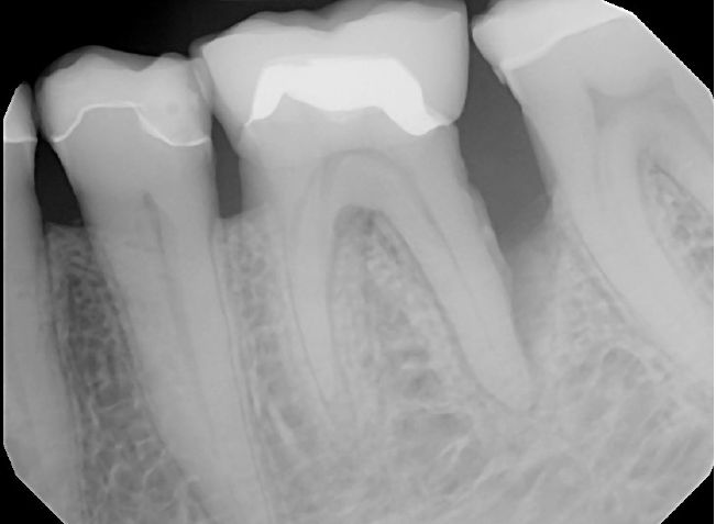 5-#19 before bone graft