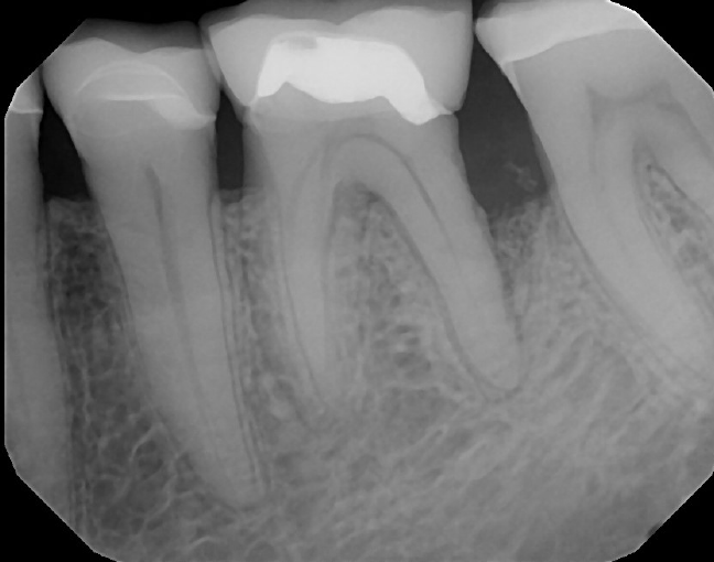 5a- #19 bone graft 2 years