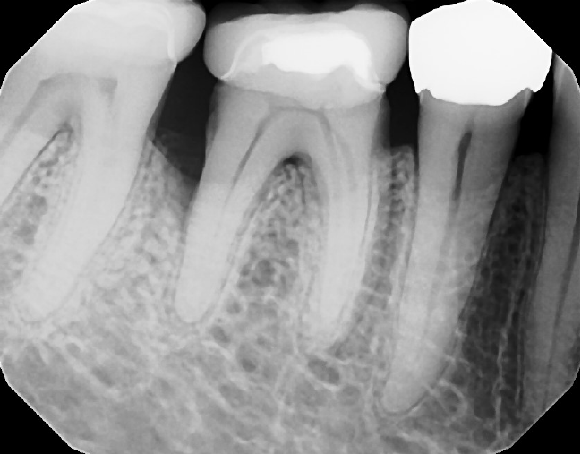 6-#30 Bone graft Before