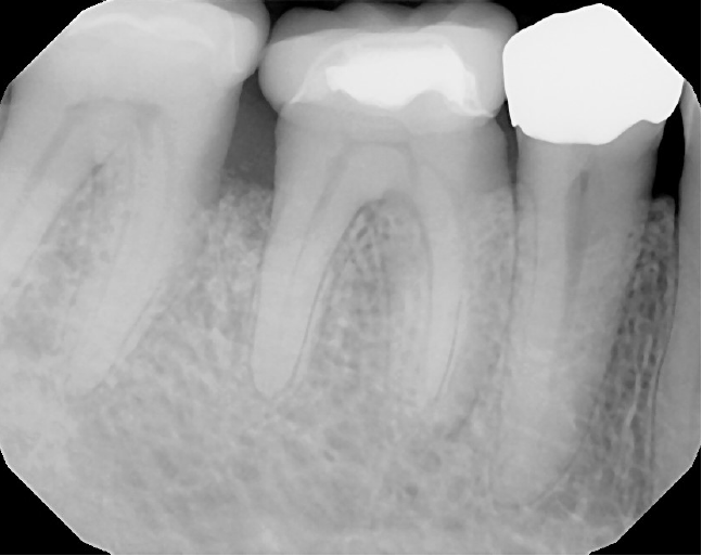 6a-#30 Bone graft 3 years after