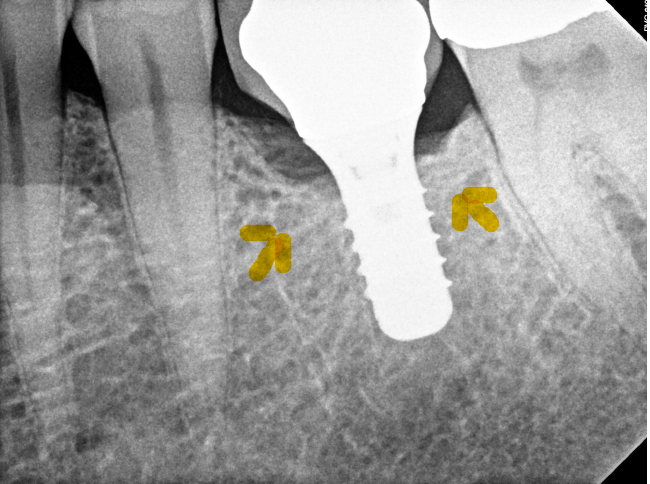 7-implant Bone graft Before