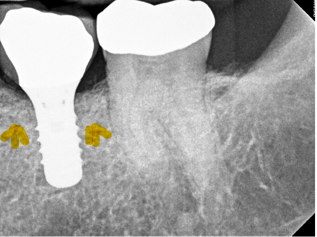 7a-implant Bone graft After