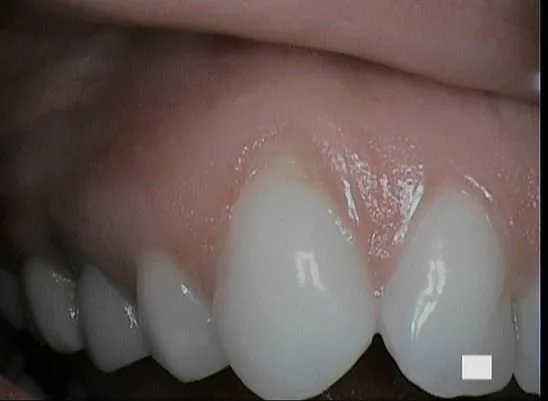 9- #6 before