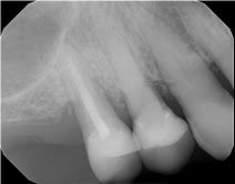 Kathy Bone graft 6 years after