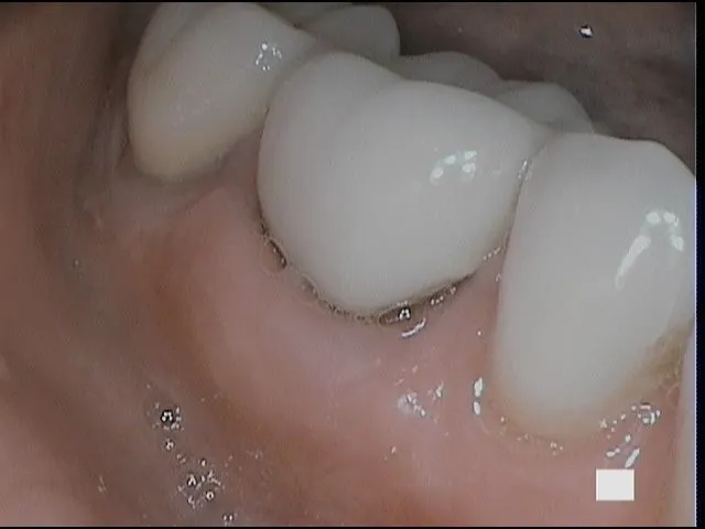 Molar after