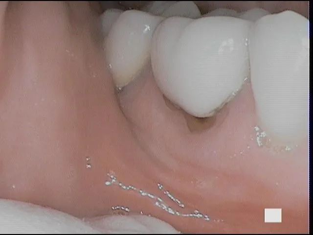 Molar before