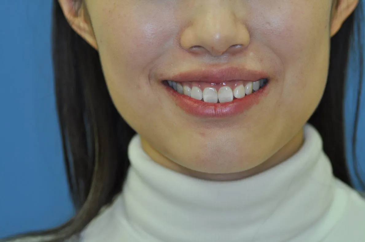 after gummy smile
