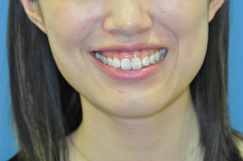 before gummy smile