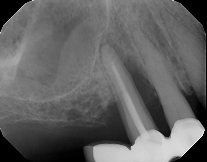 kathy before Bone graft