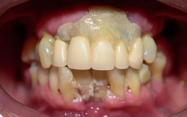 closeup before full mouth implants