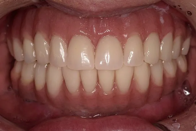 closeup after full mouth implants