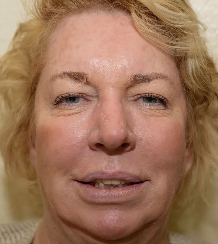 before full mouth implants
