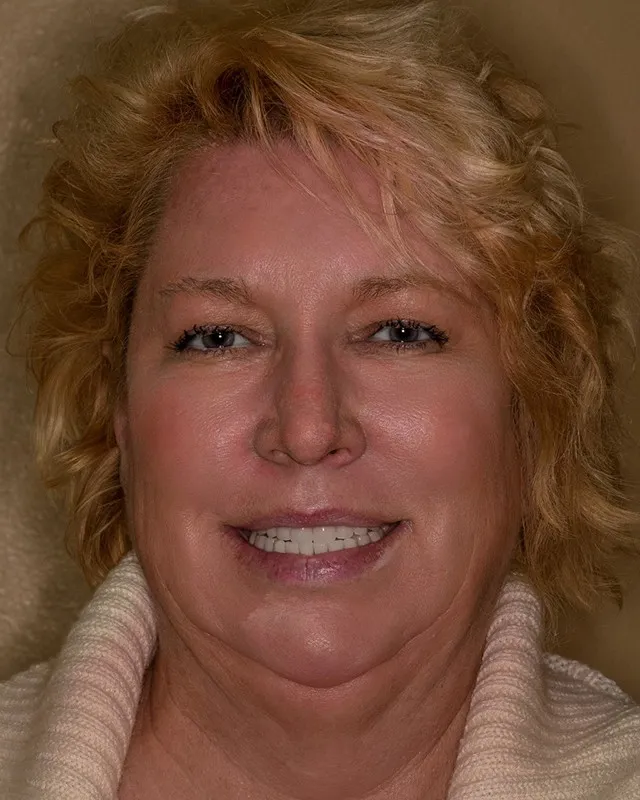 after full mouth implants